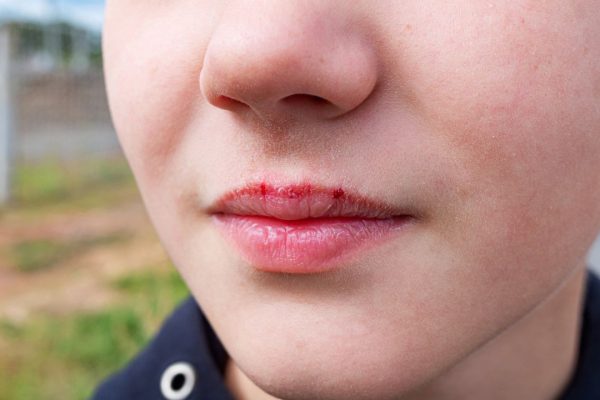 10 Kesalahan dalam Merawat Bibir yang Harus Dihindari 10 Kesalahan dalam Merawat Bibir yang Harus Dihindari