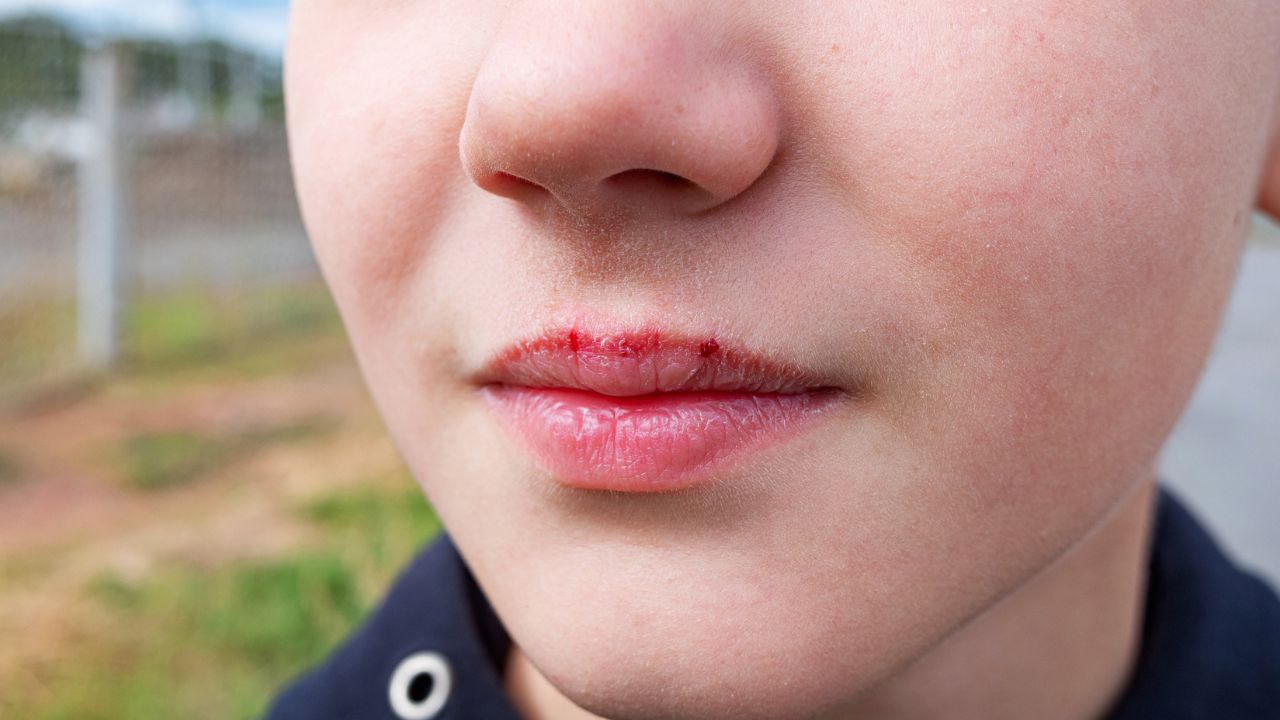 10 Kesalahan dalam Merawat Bibir yang Harus Dihindari