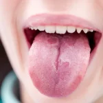 7 Jenis Gangguan Lidah yang Harus Kamu Tahu