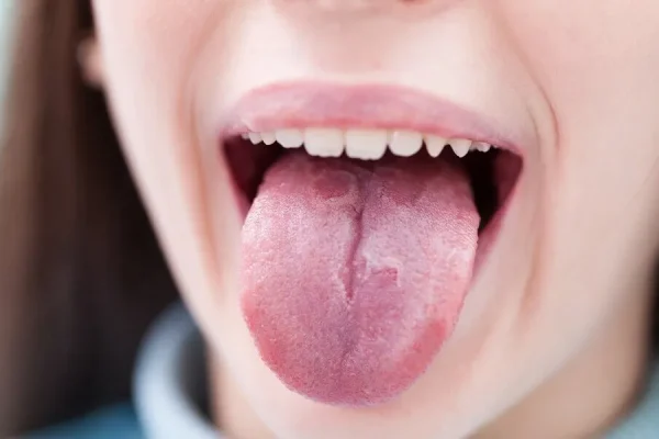 5 Cara Mengembalikan Sensitivitas Lidah yang Hilang 5 Cara Mengembalikan Sensitivitas Lidah yang Hilang