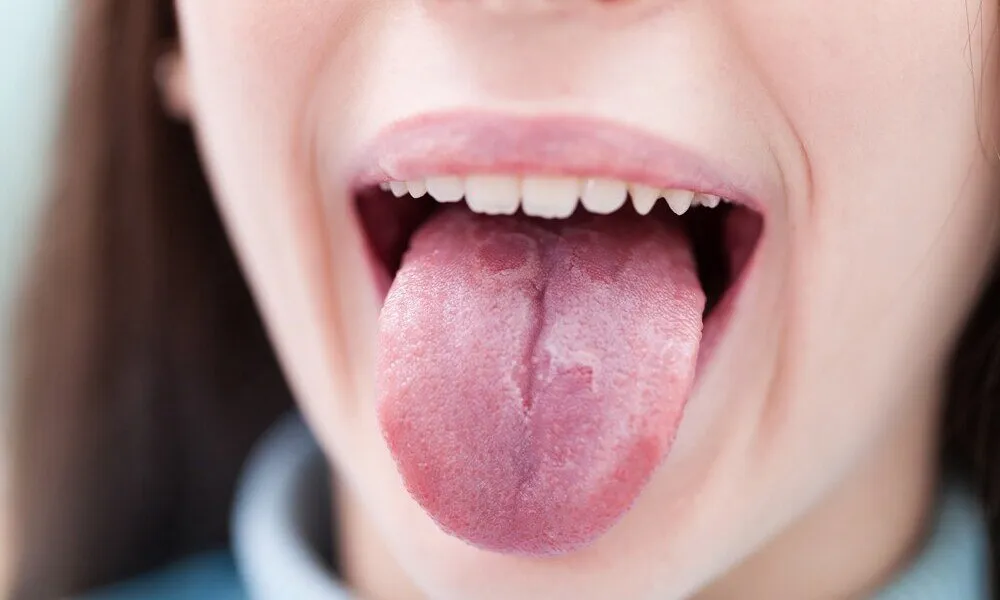 5 Cara Mengembalikan Sensitivitas Lidah yang Hilang