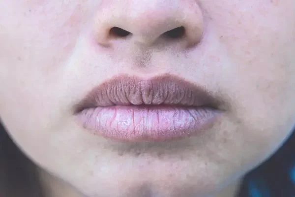 5 Cara Mencegah Bibir Menghitam Akibat Rokok 5 Cara Mencegah Bibir Menghitam Akibat Rokok
