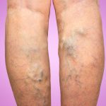 7 Cara Mengatasi Varises Secara Alami