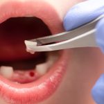 7 Tips Merawat Gusi Setelah Cabut Gigi