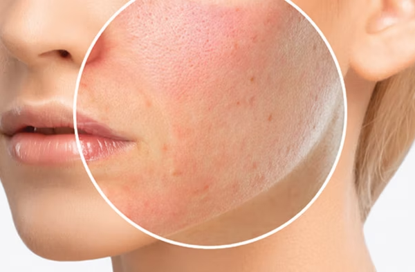 7 Cara Mengatasi Alergi Kulit Akibat Penggunaan Produk Kosmetik