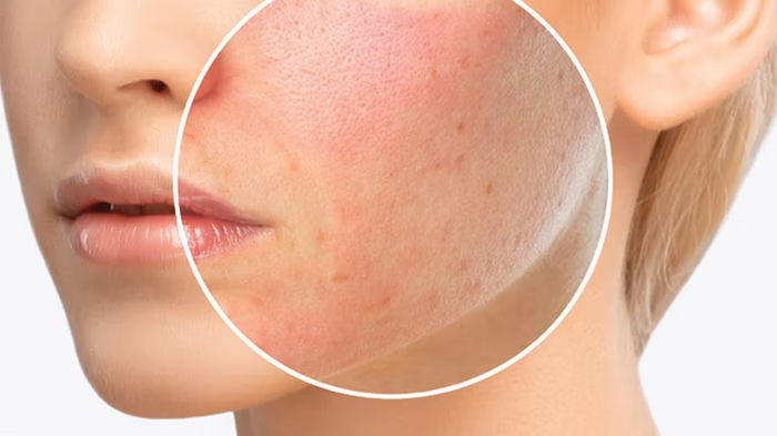 7 Cara Mengatasi Alergi Kulit Akibat Penggunaan Produk Kosmetik