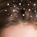 7 Cara Mengurangi Ketombe Tanpa Harus ke Salon