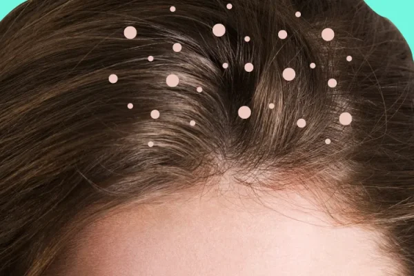 7 Cara Mengurangi Ketombe Tanpa Harus ke Salon