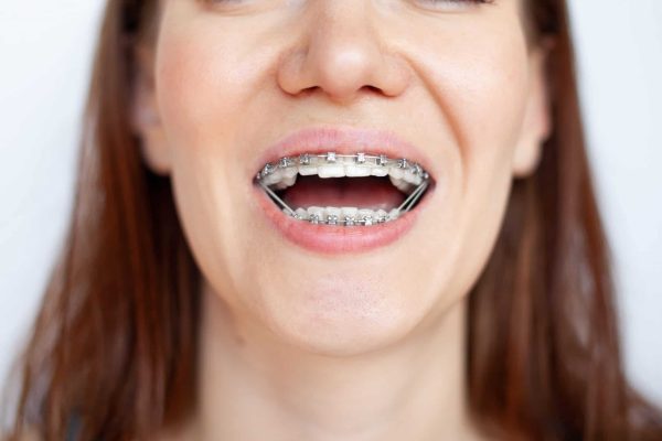 7 Cara Menjaga Kesehatan Rahang Saat Menggunakan Behel