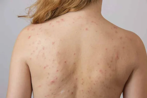 10 Tips Atasi Jerawat Punggung Secara Efektif