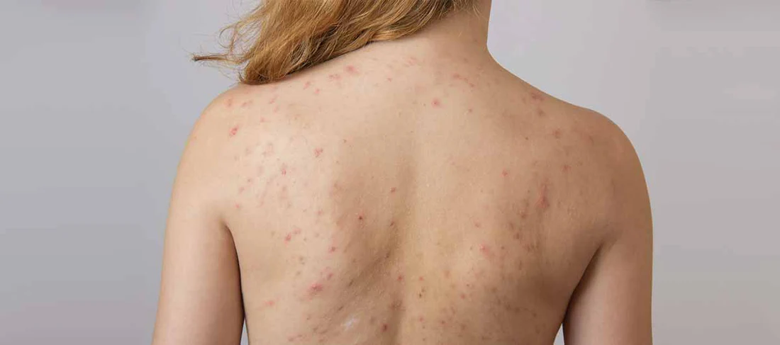 10 Tips Atasi Jerawat Punggung Secara Efektif